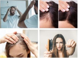 best shampoo for hair loss female, hair loss causes, What is the main reason for hair loss in females?,How can I stop my hair loss?, What type of vitamin deficiency causes hair loss?